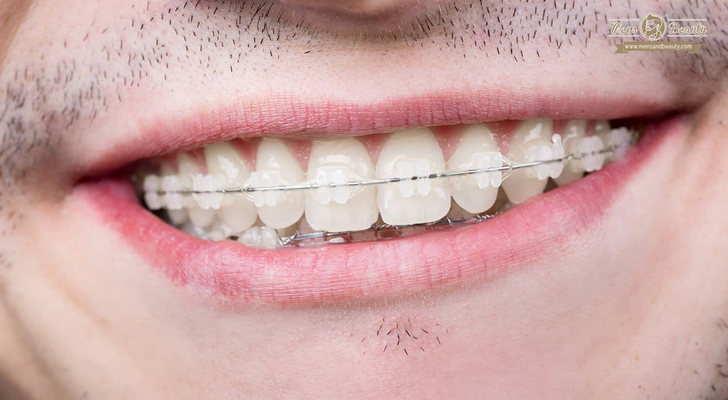brackets hombre aparato dental dientes ortodoncia